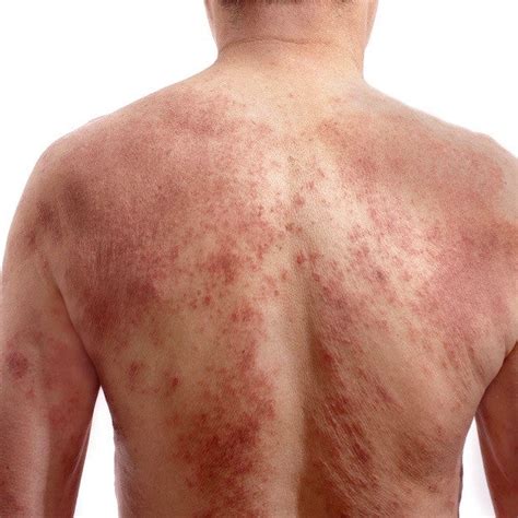 What is red skin syndrome? – Eczema Life