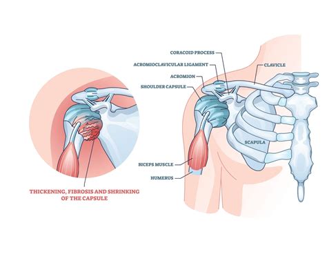 Dealing With Acromion Pain With The Best Exercises For Relief | Physiotherapists in Toronto ...