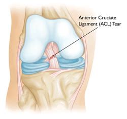 Are ACL Injuries Hereditary? | SiOWfa15: Science in Our World ...