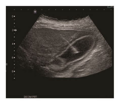 IR-guided cholecystostomy tube placement and drainage and irrigation of... | Download Scientific ...