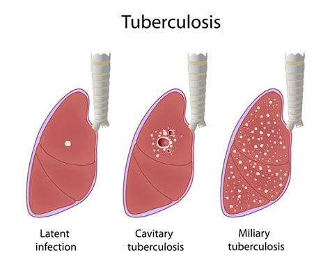 The true burden of tuberculosis