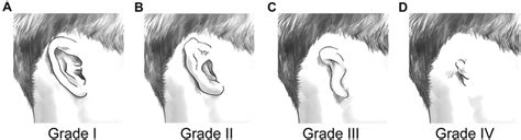 Microtia grading. A Grade I. All the external ear structures are ...