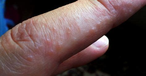 7 Dermatitis herpetitis ideas | dermatitis, dermatitis herpetiformis, gluten allergy