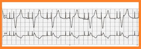 Float Nurse: Practice EKG Strips 405