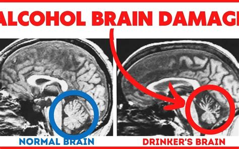 11 Ways Alcohol Induces Brain Damage Archives - Alcohol Mastery