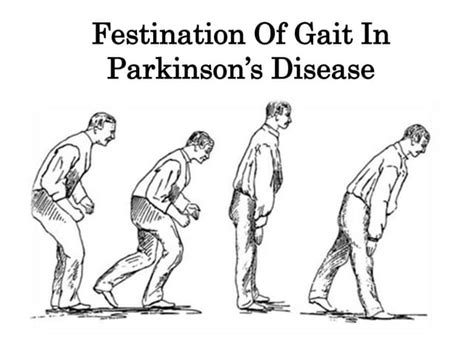 Parkinson Gait Pattern