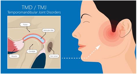 TMJ Albuquerque, NM - TMJ Treatment - Peak Family Dentistry