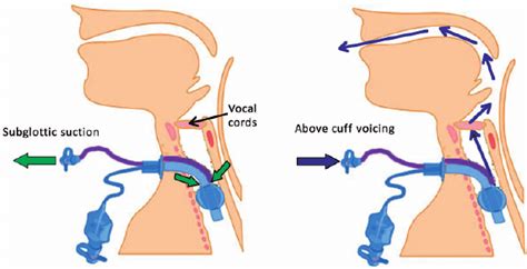 Tracheostomy Tube Suctioning