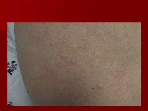 PPT - Urticaria and Angioedema PowerPoint Presentation, free download - ID:4008143