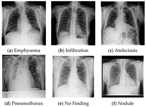 Healthy Lungs Vs Smokers Lungs X Ray