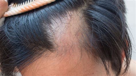 Alopecia Areata: Causes, Symptoms, Management and Clinical Features