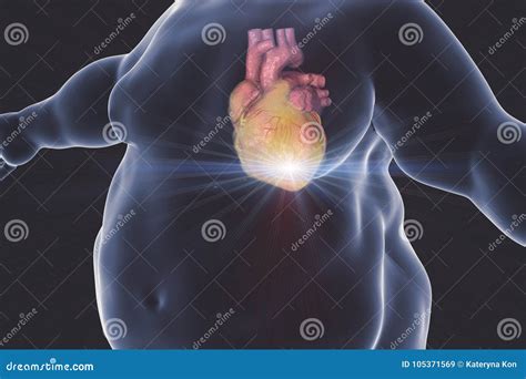 Heart Disease in Obesity Person Stock Illustration - Illustration of isolated, obesity: 105371569