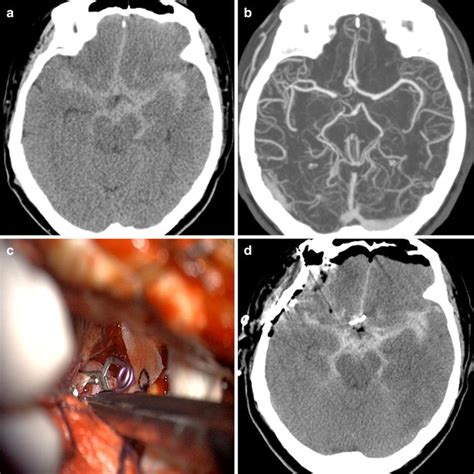 Axial non-contrast CT scan showed diffuse SAH in the basal cisterns,... | Download Scientific ...