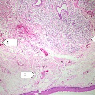 (PDF) Hamartomatous polyp of the tonsil: a case report