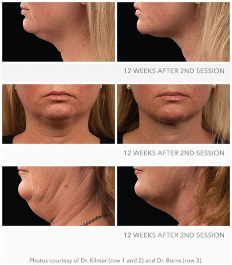 diy coolsculpting double chin - Sharyn Abreu