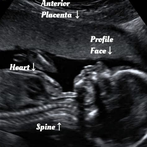 Guide for your normal 17 week Ultrasound. - Ultrasoundfeminsider