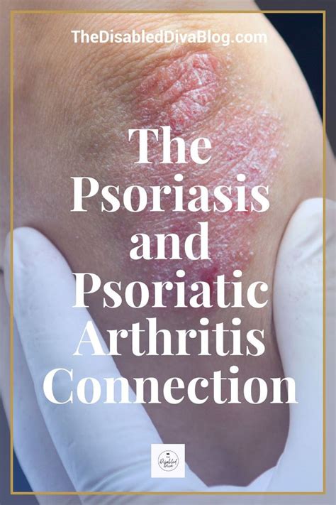 Psoriatic Arthritis Symptoms, Arthritis Causes, Psoriasis Arthritis ...