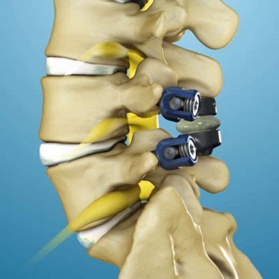 Spinal Stenosis Treatment | TOPS™ System by Premia Spine
