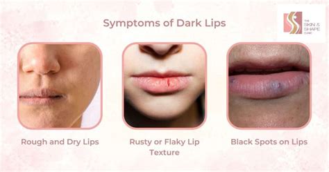 Dark Lips Treatment by Dermatologist - The Skin & Shape