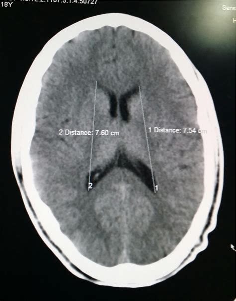 Normal Brain Mri Ventricles