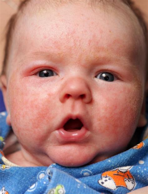 What are the Most Common Symptoms of a Baby Eye Infection?