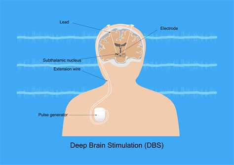 Brain Surgery for Parkinson's Disease: Overview