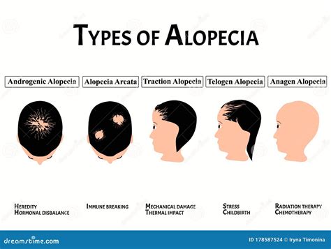 Types of Alopecia. Bald Spot, Baldness, Alopecia Mesotherapy. Causes of ...