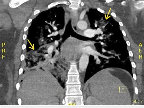 CT pulmonary angiogram taken on day 2 of hospitalization. Imaging... | Download Scientific Diagram