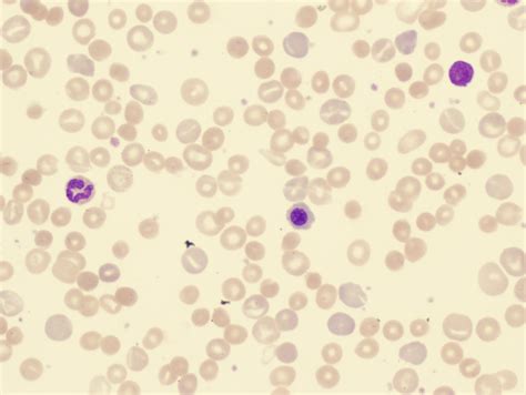 View Anemia Hemolítica Microangiopática Pdf Pics - Arthur K. Reed