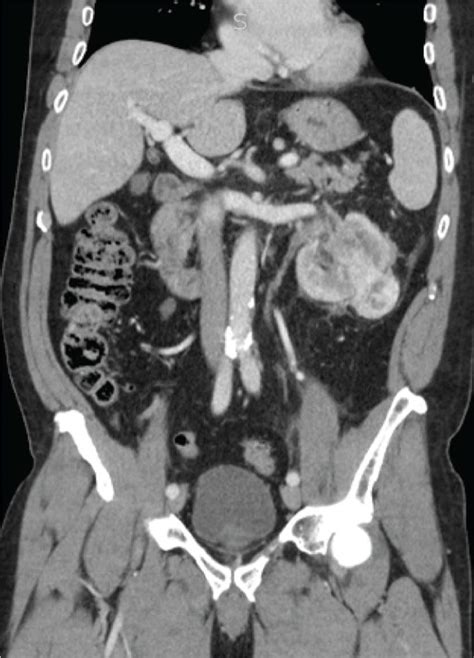 Computed tomography of renal mass demonstrating exophytic and ...