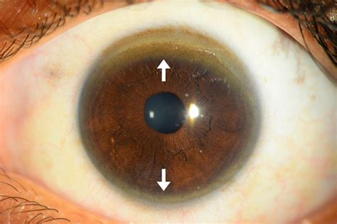 Anterior segment optical coherence tomography to look for Kayser-Fleischer rings | Practical ...