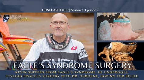 Eagle Syndrome Surgery Changed My Life! - YouTube