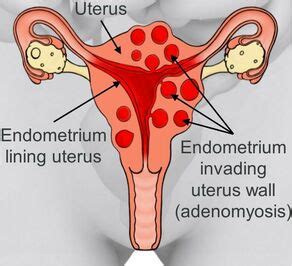 Adenomyosis - TheodoraBobbi