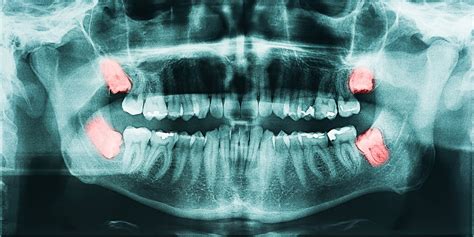 Common Myths about Wisdom Teeth