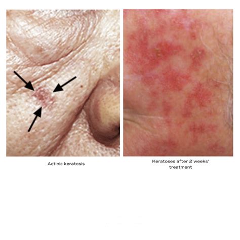 Treatment Options for Actinic Keratosis - Renew Dermatology ...