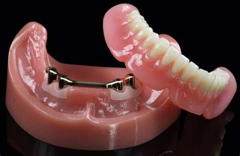 Implant overdenture prosthesis - Specialized dental studio “Aponia ...