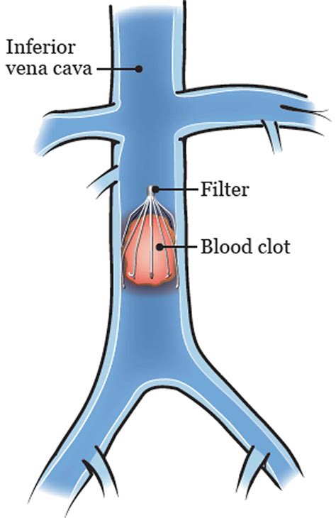 Inferior vena cava anatomy, function, filter & inferior vena cava syndrome