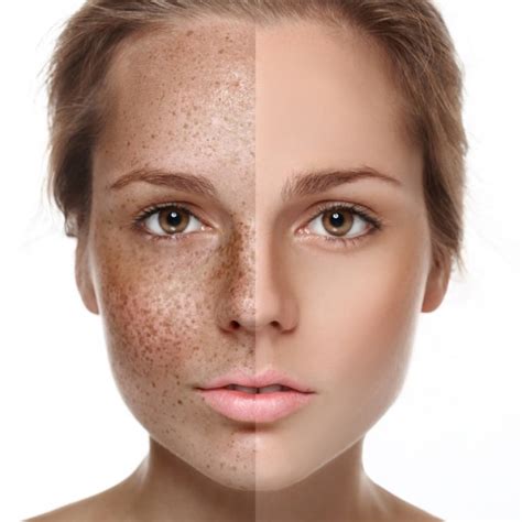 Sun Spot and Age Spot Removal | Dermatology Care of Charlotte | Dermatology Care of Charlotte