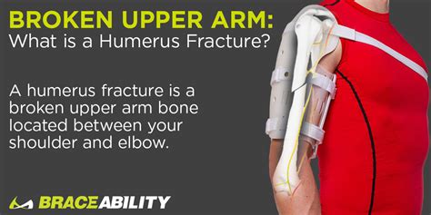 Proximal Humerus Fracture Splint