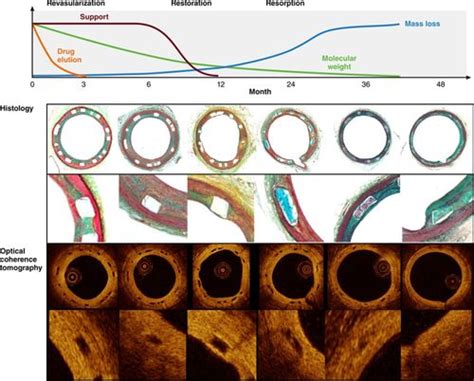 Bioresorbable Vascular Scaffolds for Coronary Revascularization ...