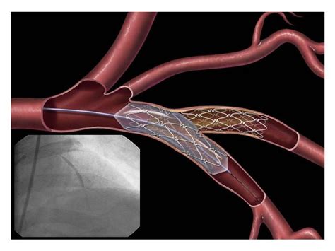 Portal Ratownik-med.pl - Kardiologia inwazyjna to kura znosząca złote jaja