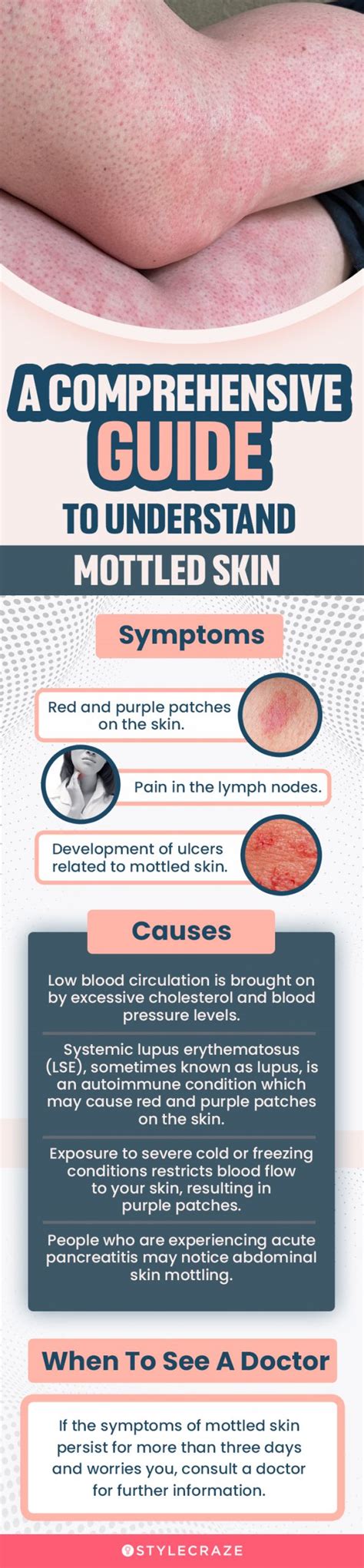 Mottled Skin : Causes, Symptoms, Diagnosis, And Treatment