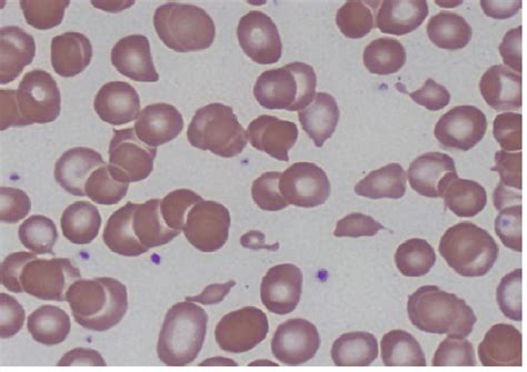 Peripheral smear showing schistocytes or helmet cells. | Download ...