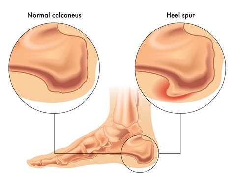 Physical Therapy for Bone Spurs | Heel Spurs