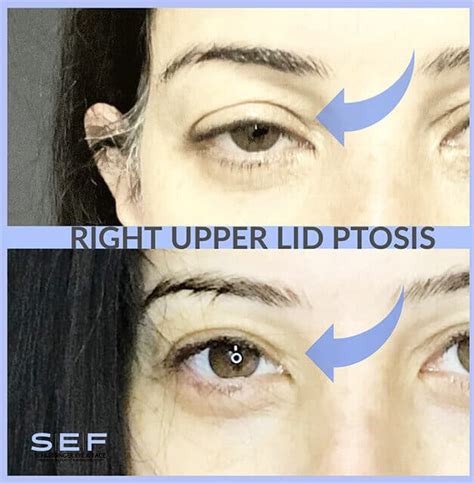 Ptosis Before & After Gallery | Schlessinger Eye & Face Woodbury, NY