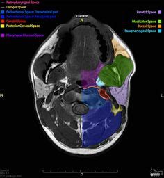 Deep spaces of the head and neck: annotated MRI | Radiology Case ...