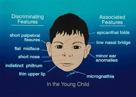 Down Syndrome Symptoms Diagram