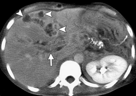 Pylephlebitis in a 50-year-old man with symptoms of abdominal sepsis.... | Download Scientific ...