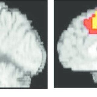 Conflict-and Error-Related Anterior Cingulate Cortex Activity in... | Download Scientific Diagram