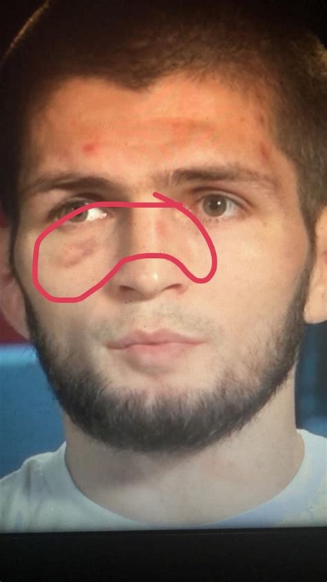 Rare picture of Khabib marked up and bruised, scary to think that man ...